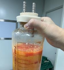 来宾水动力吸脂手术要做多久？